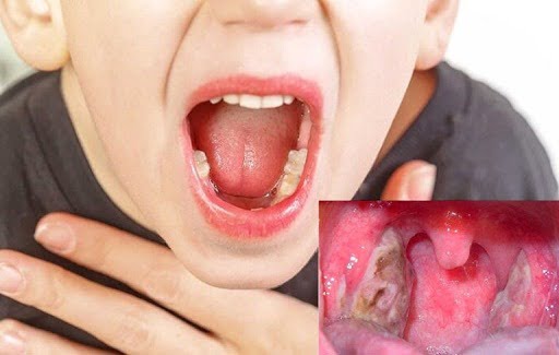 Viêm amidan có mủ sẽ xuất hiện những mảng trắng đục trong họng