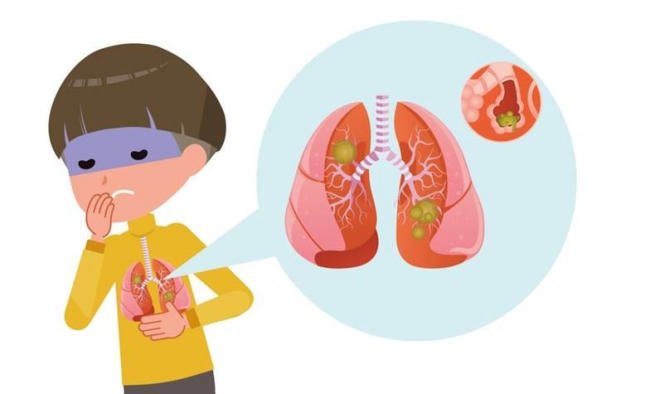 Cha mẹ chớ chủ quan với viêm phế quản phổi ở trẻ