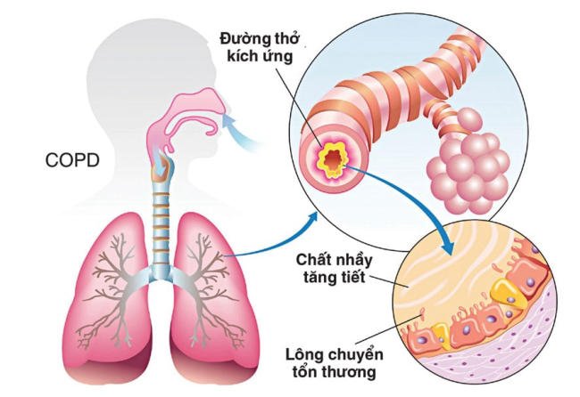 Tắc nghẽn phổi mãn tính gây ho có đờm